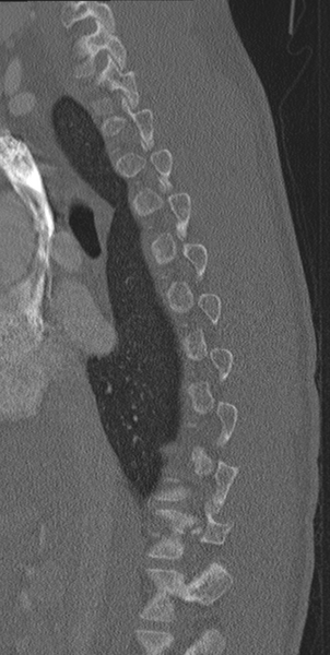 File:Normal CT thoracic spine (Radiopaedia 40181-42688 Sagittal bone window 45).png