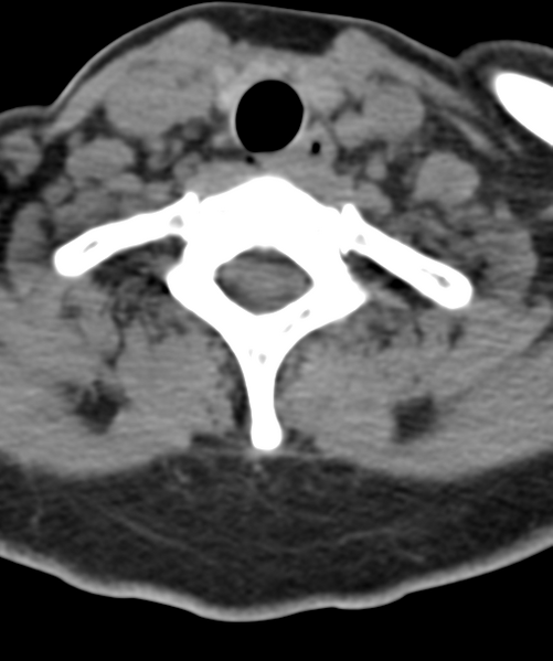 File:Normal cervical spine MRI (including Dixon) (Radiopaedia 42762-45926 Axial non-contrast 49).png
