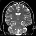 Normal coronal brain (Radiopaedia 6676-7910 Coronal T2 25).jpg