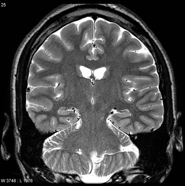 File:Normal coronal brain (Radiopaedia 6676-7910 Coronal T2 25).jpg