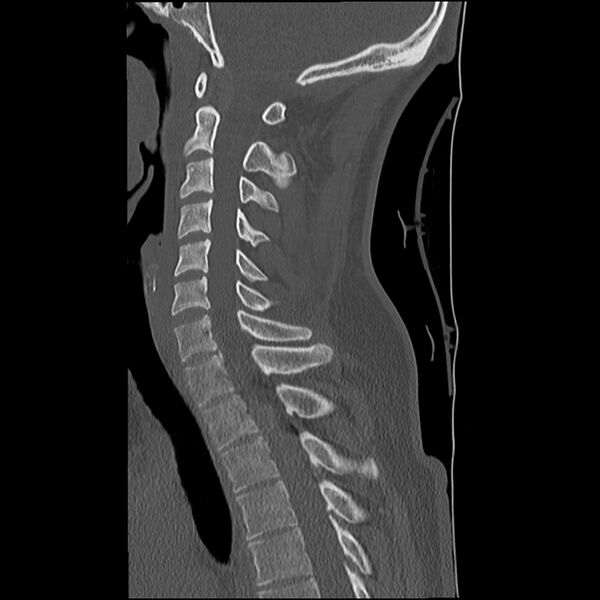 File:Normal trauma spine imaging (Radiopaedia 31753-32686 Sagittal bone window 22).jpg
