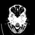 Obstructive hydrocephalus (Radiopaedia 30453-31119 Axial non-contrast 3).jpg
