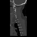 Occipital condyle fracture (Radiopaedia 31755-32691 Sagittal bone window 7).jpg