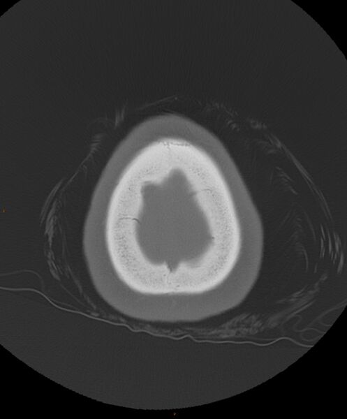 File:Occipital condyle fracture (Radiopaedia 61165-69056 Axial bone window 2).jpg
