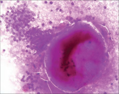 Cytology smear shows a ruptured sporangium with many endospores