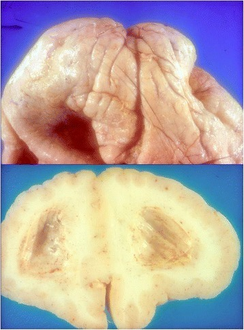 Severe architectural disarrangement with clear signs of lissencephaly