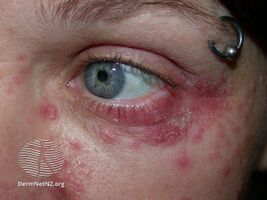Periorbital dermatitis
