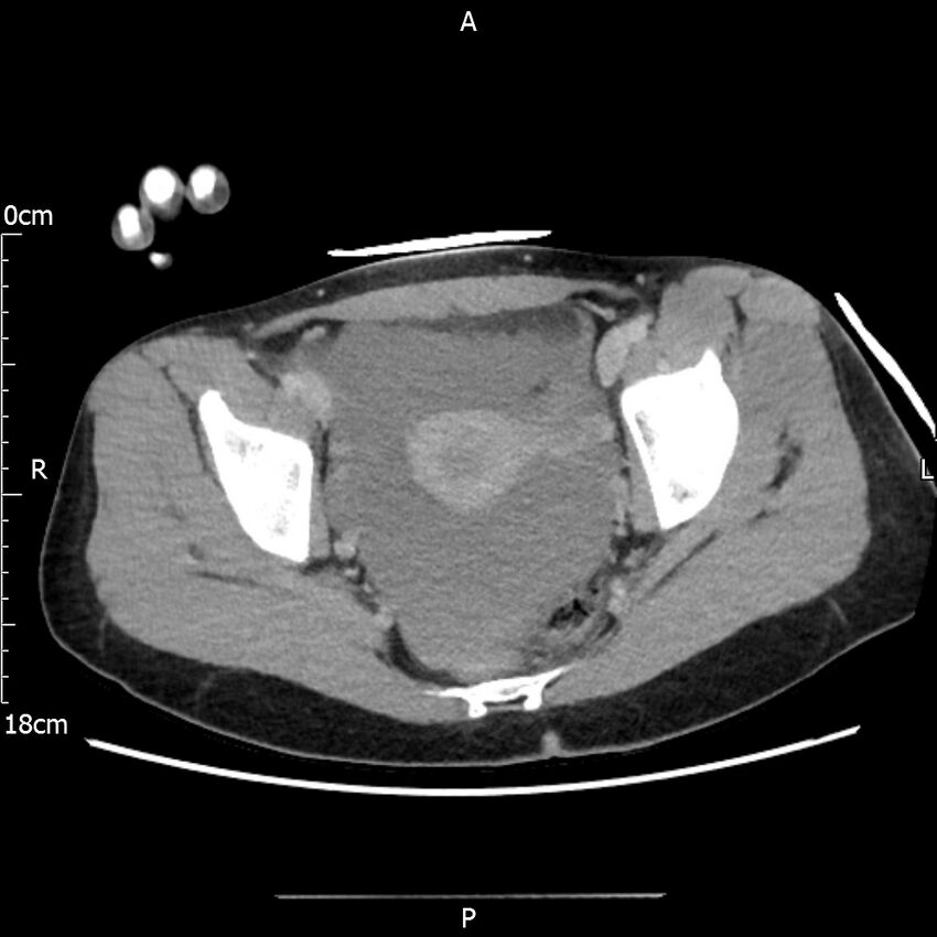 AAST grade IV kidney injury with CEUS follow-up (Radiopaedia 72353-82877 Axial C+ portal venous phase 69).jpg