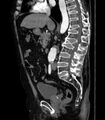 Abdominal aortic aneurysm (Radiopaedia 25855-26001 Sagittal C+ arterial phase 22).jpg