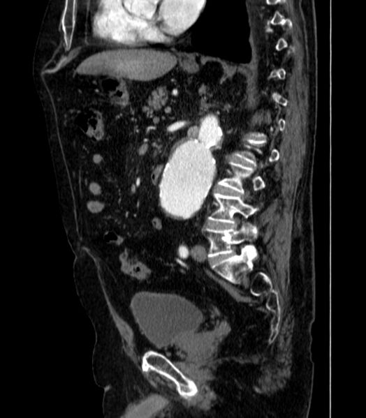 File:Abdominal aortic aneurysm (Radiopaedia 25855-26001 Sagittal C+ arterial phase 34).jpg