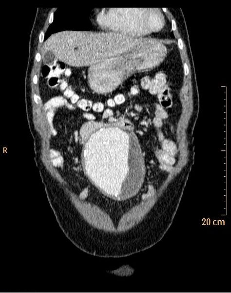 File:Abdominal aortic aneurysm (Radiopaedia 25985-26121 Coronal C+ arterial phase 2).jpg