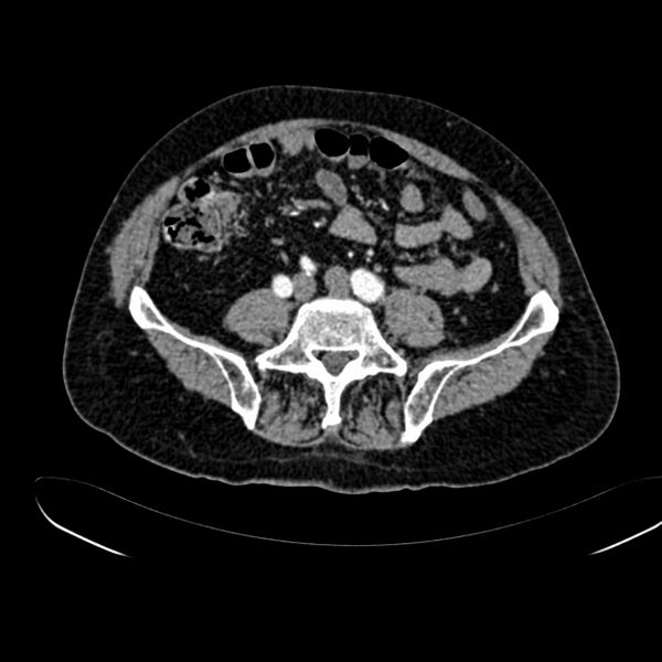 File:Abdominal aortic aneurysm (Radiopaedia 75131-86203 Axial C+ arterial phase 31).jpg