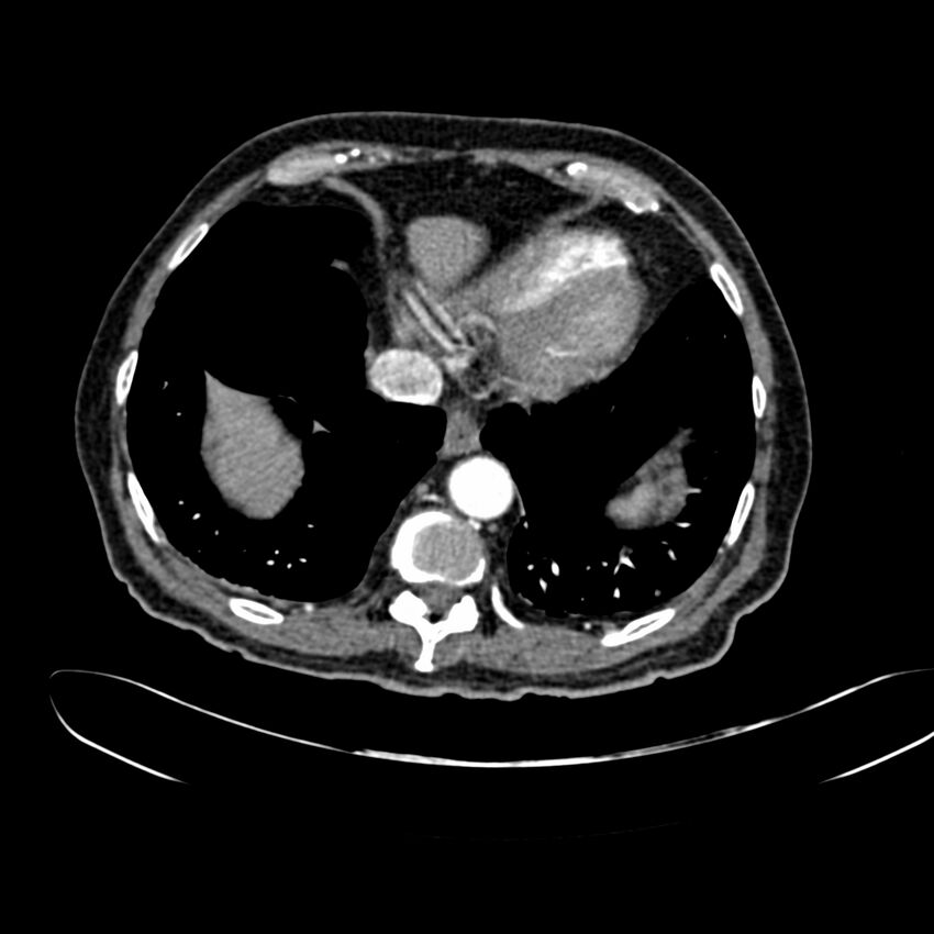 Abdominal aortic aneurysm (Radiopaedia 75131-86203 Axial C+ arterial phase 6).jpg