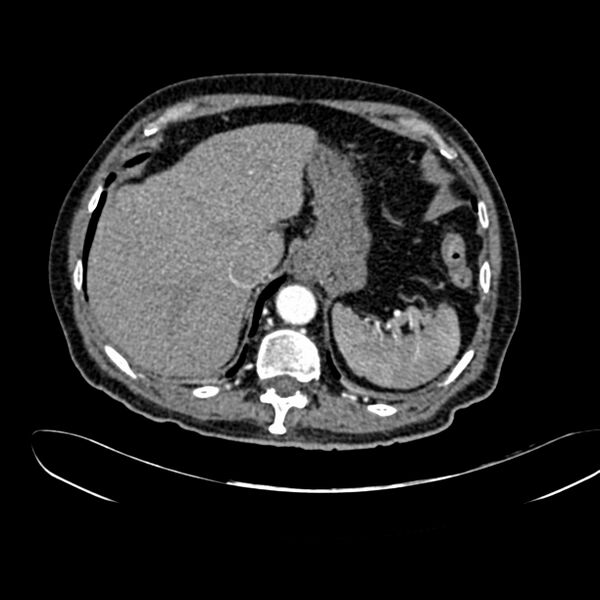 File:Abdominal aortic aneurysm (Radiopaedia 75131-86203 Axial C+ arterial phase 9).jpg