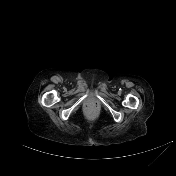 File:Abdominal aortic aneurysm - impending rupture (Radiopaedia 19233-19246 Axial non-contrast 134).jpg