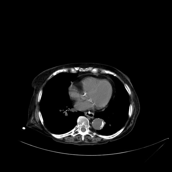 File:Abdominal aortic aneurysm - impending rupture (Radiopaedia 19233-19246 Axial non-contrast 8).jpg