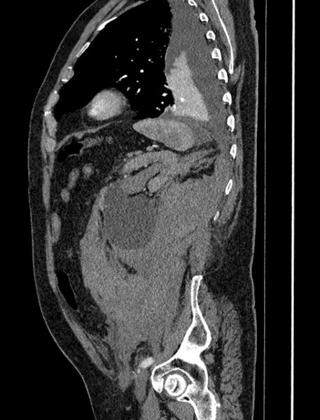 File:Abdominal aortic aneurysm rupture (Radiopaedia 54179-60362 Sagittal C+ arterial phase 33).jpg