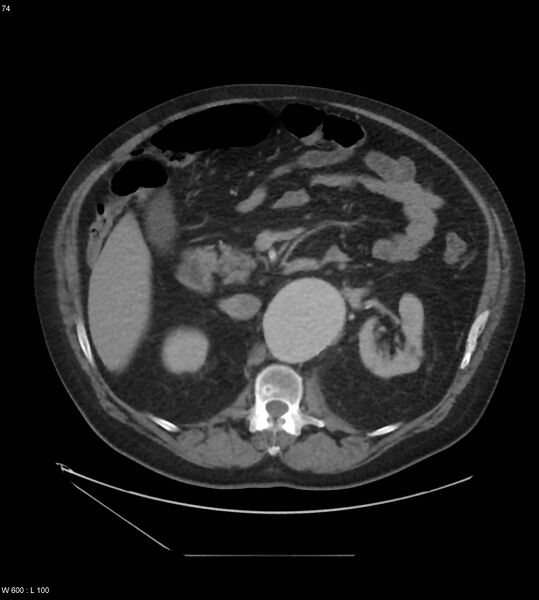 File:Abdominal aortic aneurysm with intramural hematoma then rupture (Radiopaedia 50278-55631 Axial C+ arterial phase 65).jpg