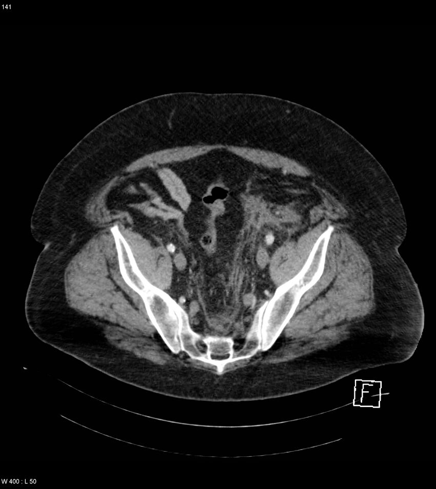 Abdominal aortic aneurysm with intramural hematoma then rupture (Radiopaedia 50278-55632 Axial C+ arterial phase 140).jpg