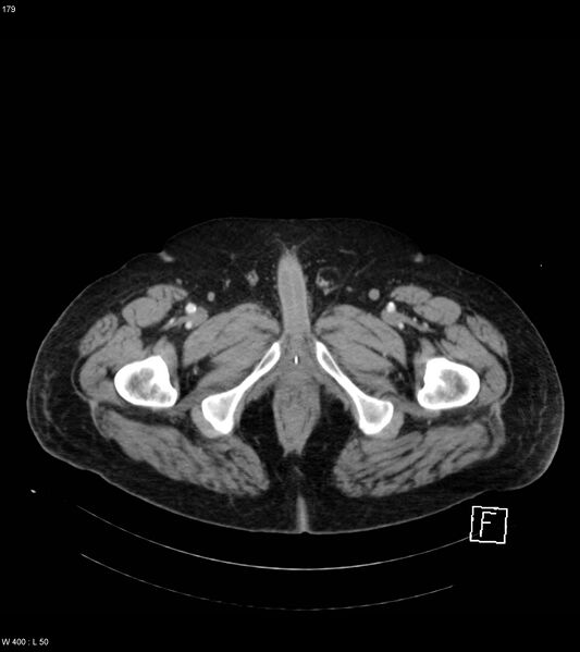 File:Abdominal aortic aneurysm with intramural hematoma then rupture (Radiopaedia 50278-55632 Axial C+ arterial phase 178).jpg