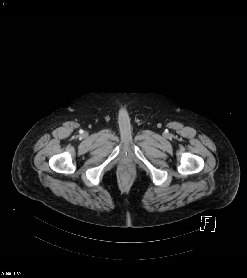 Abdominal aortic aneurysm with intramural hematoma then rupture (Radiopaedia 50278-55632 Axial C+ arterial phase 178).jpg