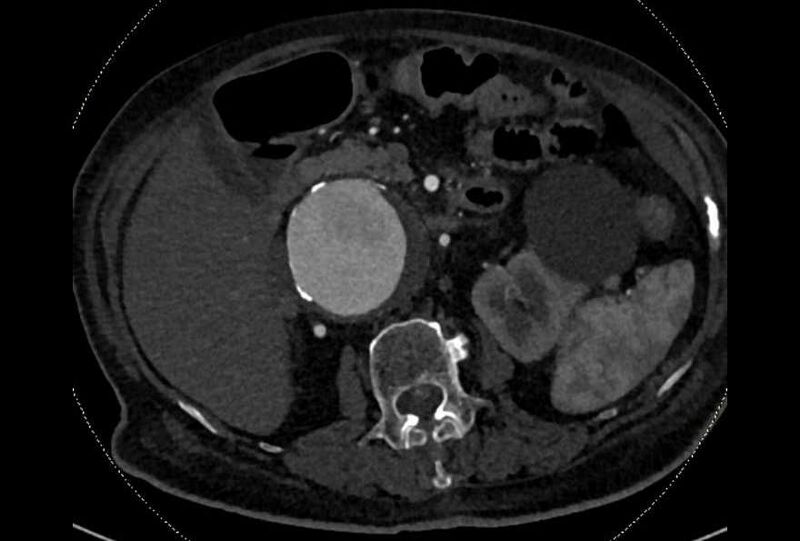 File:Abdominal aortic aneurysm with thrombus fissuration (Radiopaedia 73192-83919 Axial C+ arterial phase 56).jpg