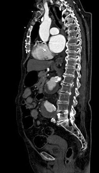 File:Abdominal aortic aneurysm with thrombus fissuration (Radiopaedia 73192-83919 Sagittal C+ arterial phase 71).jpg