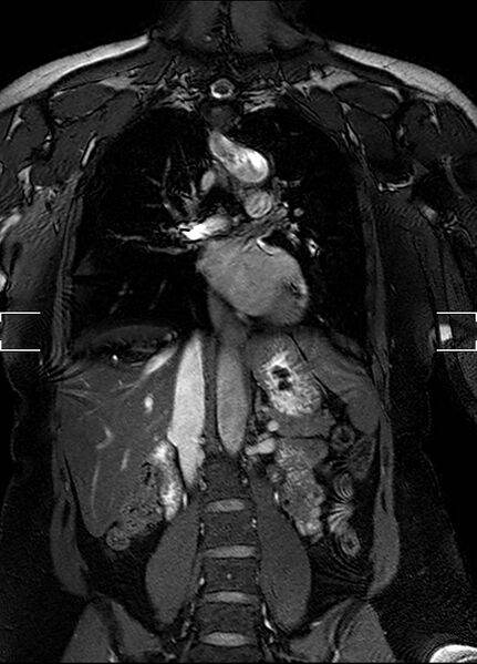File:Aberrant right subclavian artery with background Takayasu arteritis (Radiopaedia 21423-21363 Coronal MRA 16).jpg