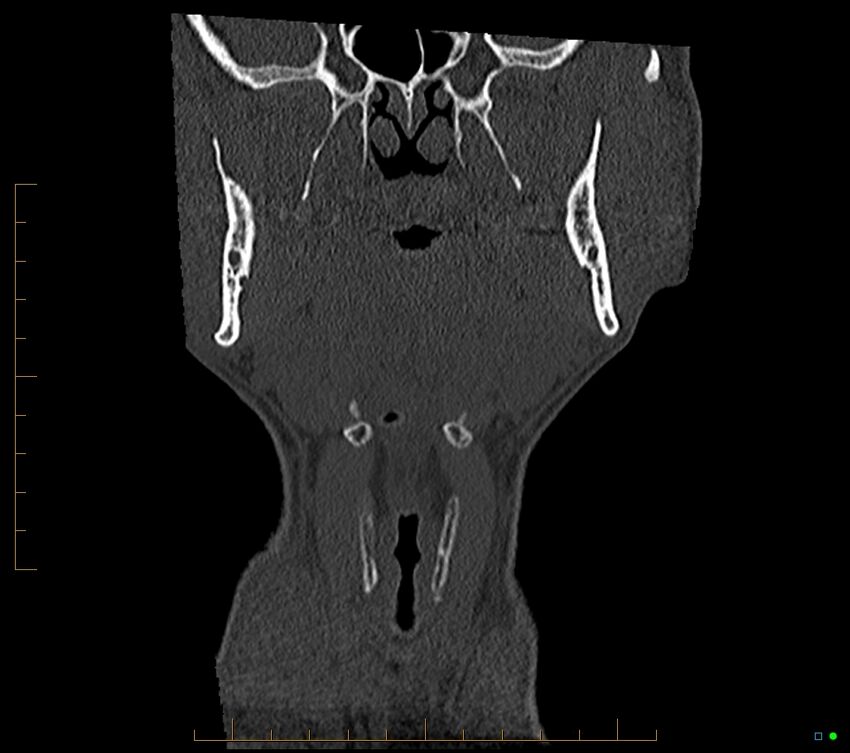 Accessory articulation of cervical transverse processes (Radiopaedia 82715-96933 Coronal non-contrast 18).jpg