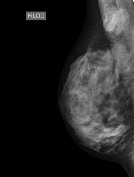 File:Accessory breast tissue (Radiopaedia 77479-89621 MLO 1).jpg