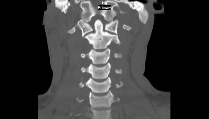 File:Accessory ossicle of the anterior arch of C1 vertebra (Radiopaedia 58149-65211 Coronal bone window 6).jpg