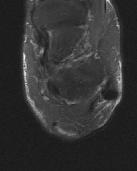 File:Achilles tendon tear (Radiopaedia 2572-6268 Axial STIR 1).jpg