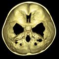 Achondroplasia (Radiopaedia 5867-7444 Axial VRT image 1).jpg