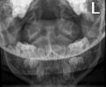 Achondroplasia (Radiopaedia 9294-9979 A 2).jpg