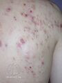 Acne affecting the back images (DermNet NZ acne-acne-back-167).jpg