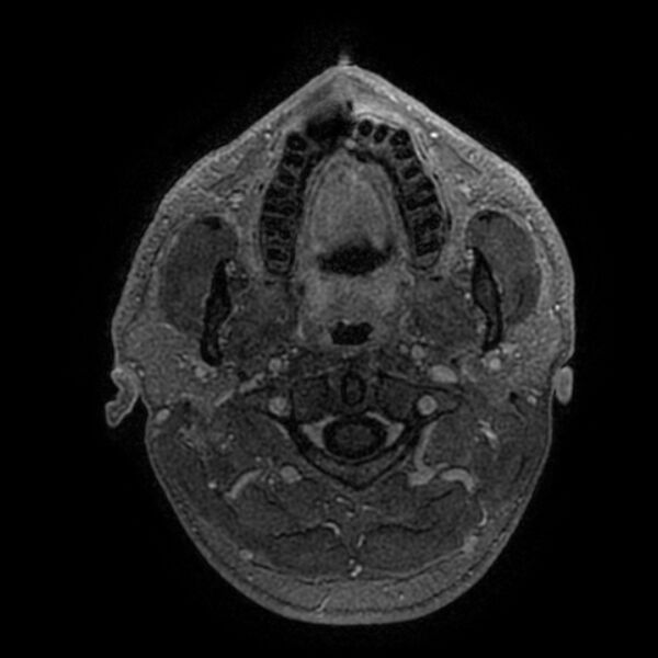 File:Acoustic schwannoma - intracanalicular (Radiopaedia 37247-39024 Axial T1 C+ 4).jpg