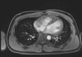 Active right ventricular cardiac sarcoidosis (Radiopaedia 55596-62100 Axial Post contrast Dixon 46).jpg