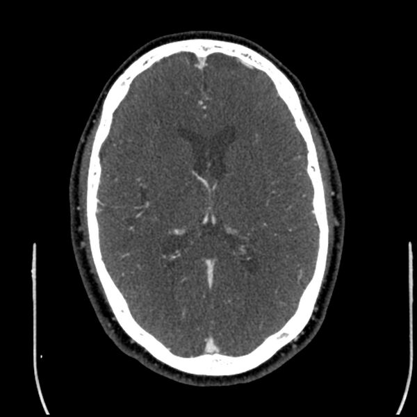 File:Acute A3 occlusion with ACA ischemic penumbra (CT perfusion) (Radiopaedia 72036-82527 Axial C+ arterial phase thins 55).jpg