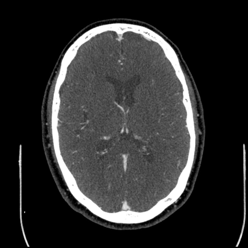 Acute A3 occlusion with ACA ischemic penumbra (CT perfusion) (Radiopaedia 72036-82527 Axial C+ arterial phase thins 55).jpg