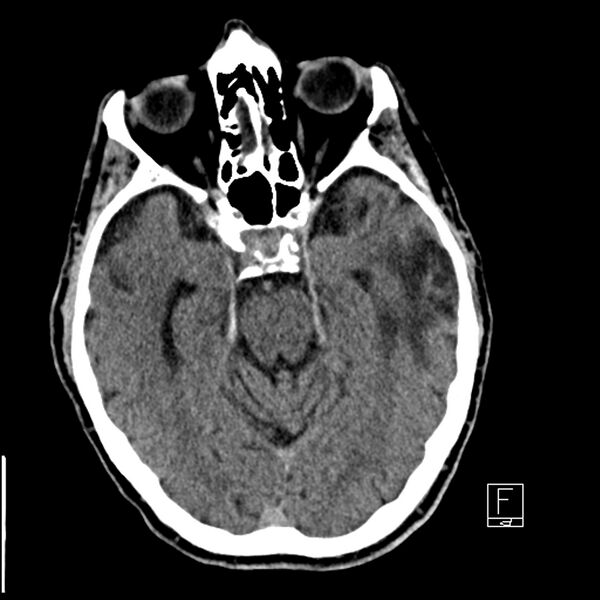 File:Acute ICA ischemic penumbra due to high-grade CCA stenosis (CT perfusion) (Radiopaedia 72038-82529 Axial non-contrast 17).jpg