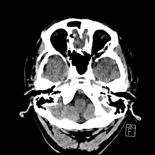 File:Acute P1 occlusion with PCA ischemia penumbra (CT perfusion) (Radiopaedia 72084-82586 Axial non-contrast 6).jpg