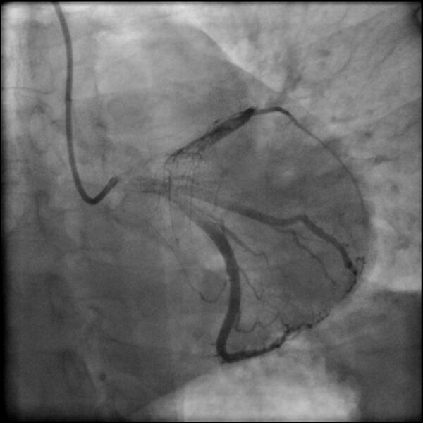 File:Acute anteroseptal myocardial infarction (Radiopaedia 68409-77946 LAO caudal (spider view) LAD and CX 43).jpg