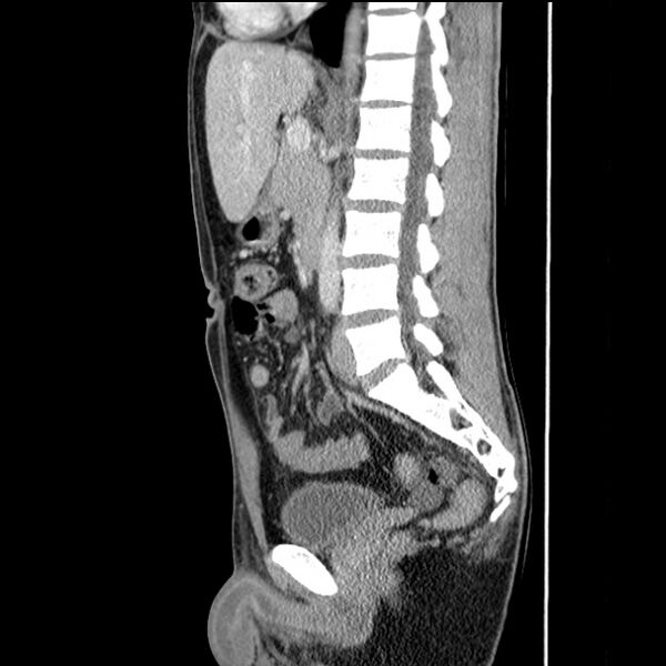 File:Acute appendicitis (Radiopaedia 27049-27227 Sagittal C+ portal venous phase 42).jpg