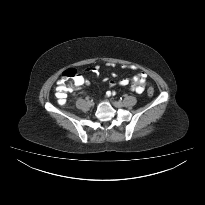 Acute appendicits - arrowhead sign (Radiopaedia 84254-99539 Axial C+ delayed 56).jpg