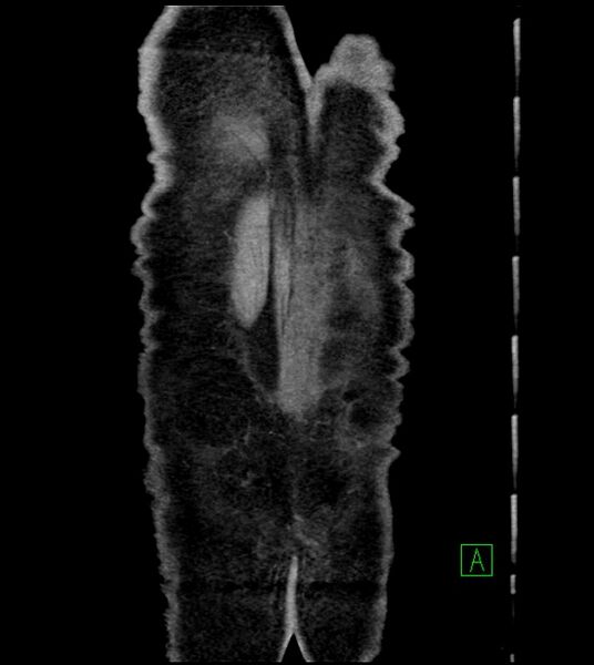 File:Acute arterial mesenteric ischemia (Radiopaedia 78238-90828 Coronal C+ portal venous phase 88).jpg