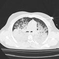 Acute aspiration pneumonitis (Radiopaedia 33605-34703 Axial lung window 40).jpg