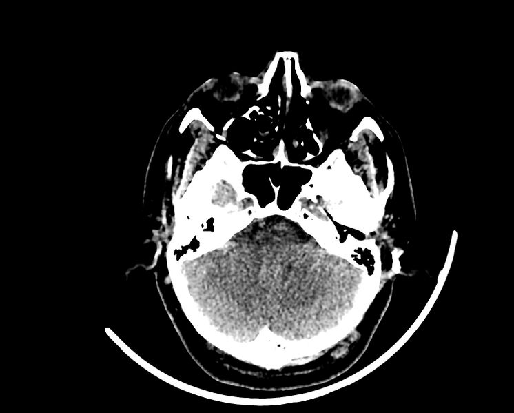 File:Acute cerebral infarct (Radiopaedia 35604-37123 Axial non-contrast 21).jpg