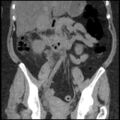 Acute cholecystitis and ureteric colic (Radiopaedia 42330-45444 Coronal prone 53).jpg