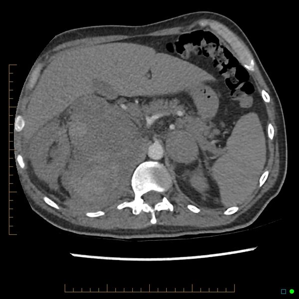 File:Acute hemorrhage into adrenal metastasis from NSCLC (Radiopaedia 43135-46429 Axial C+ CTPA 14).jpg