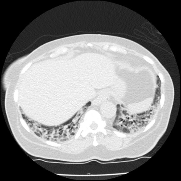 File:Acute interstitial pneumonitis (Radiopaedia 45404-49444 Axial lung window 83).jpg